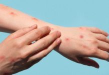 Satu dari Empat Santri yang Diduga Terinfeksi Cacar Monyet Meninggal Dunia